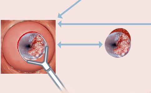 苏州治疗宫颈医院