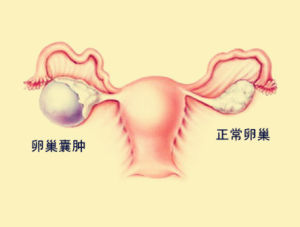 苏州治疗卵巢囊肿医院