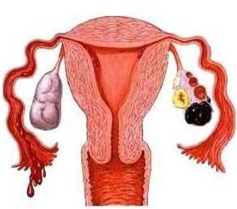 苏州卵巢囊肿医院