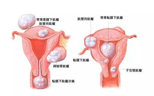 苏州子宫肌瘤治疗医院
