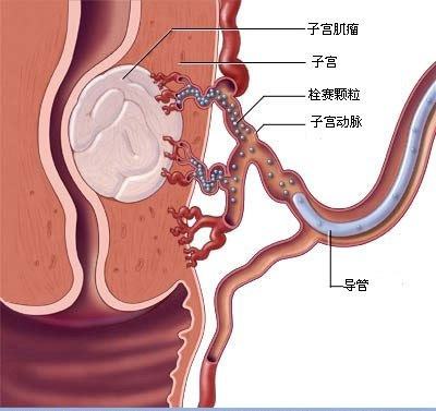 苏州子宫肌瘤治疗医院