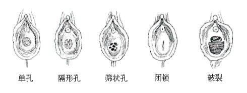 苏州处女摸修复手术