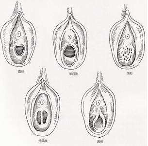 苏州处女膜修复手术医院