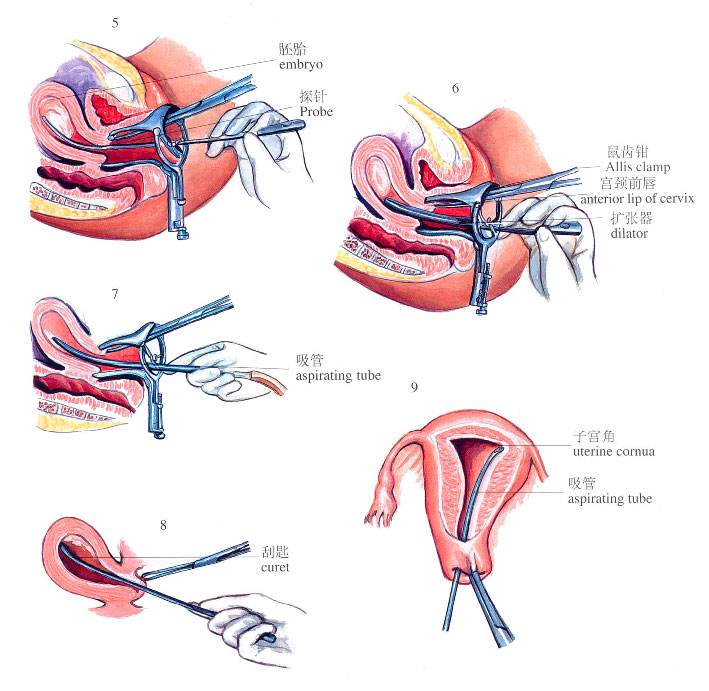 苏州无痛人流所需费用