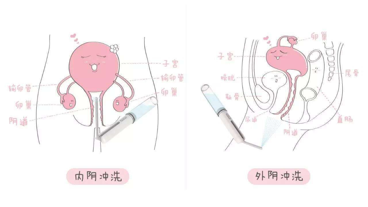 苏州哪里治疗阴道炎好