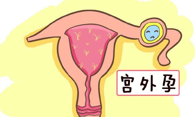 苏州怎么治疗宫外孕