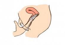 苏州治疗滴虫性阴道炎的费用