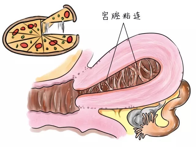 苏州治疗宫腔粘连的医院