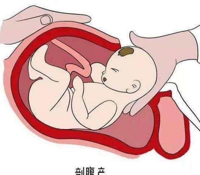 苏州做剖腹产的大概费用