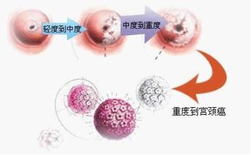苏州治疗宫颈的医院